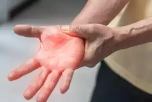 Doctors Warn Against Contaminated Food Amid Rising Cases of Guillain-Barré Syndrome in India  Surge in Guillain-Barré Syndrome Cases Raises Concerns