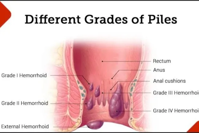 Understanding Piles: Causes, Symptoms, and Treatments...!!!