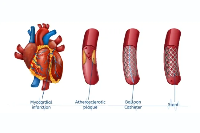 The Role of Heart Stents in Treating Coronary Artery Disease...!!!