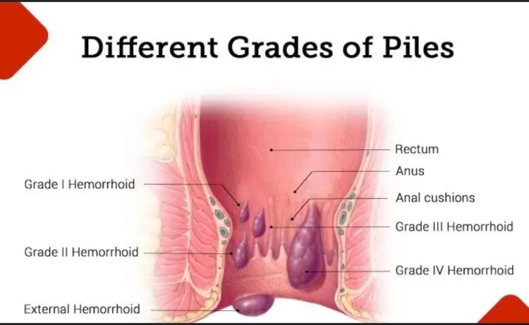 Understanding Piles: Causes, Symptoms, and Treatments...!!!