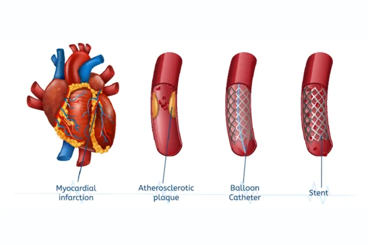 The Role of Heart Stents in Treating Coronary Artery Disease...!!!